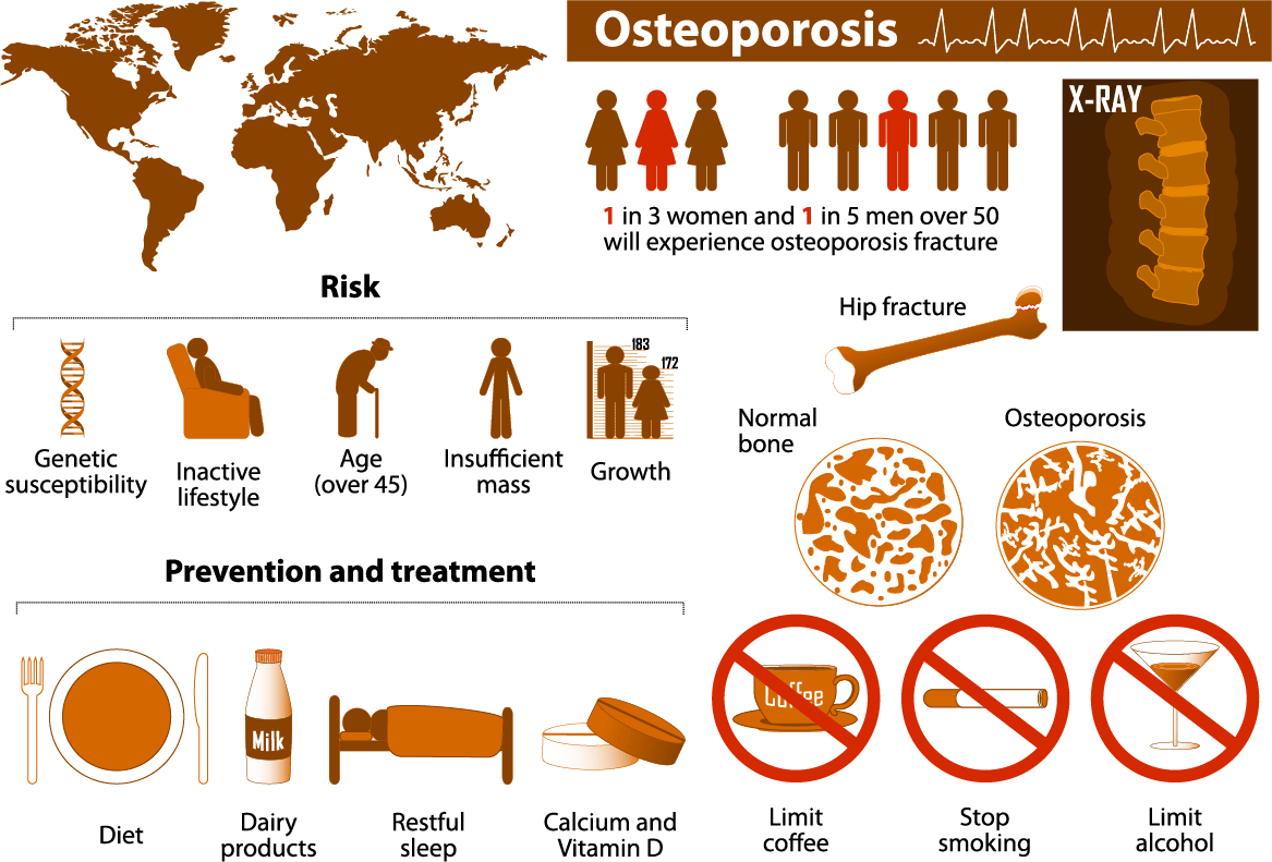 Osteoporosis+Lima+Lubbock